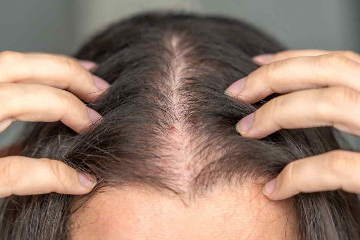Hair PRP untuk Rambut Rontok Wanita