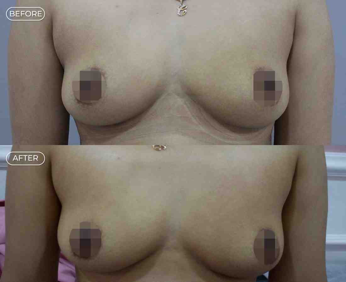 Nipple Reduction Mengecilkan Puting Payudara