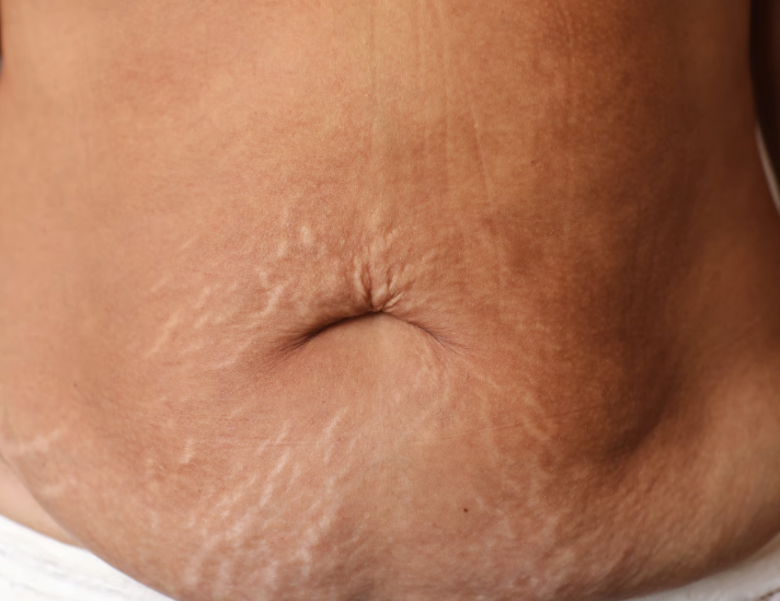 Cara Menghilangkan Stretch Mark