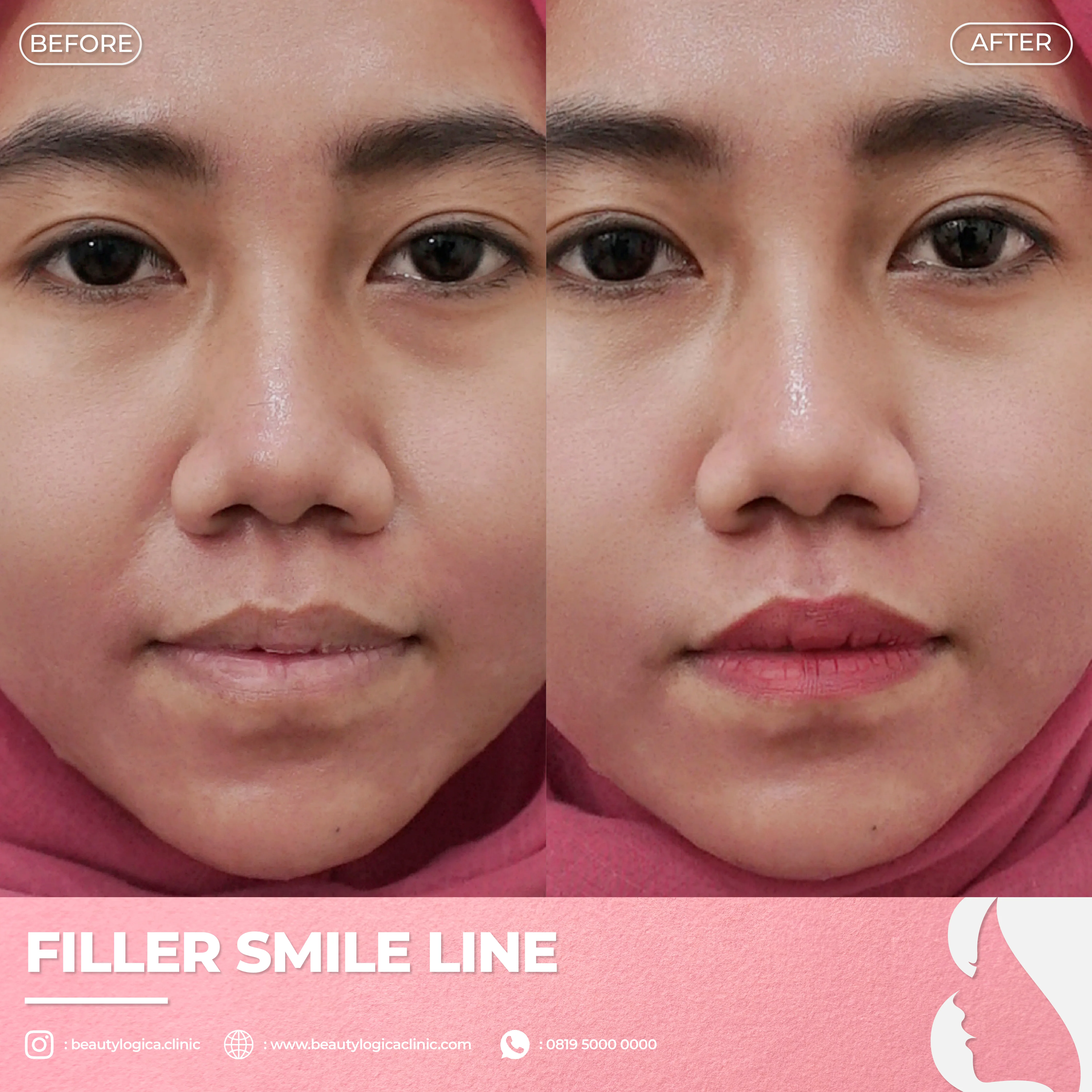 Harga Filler di Blok M