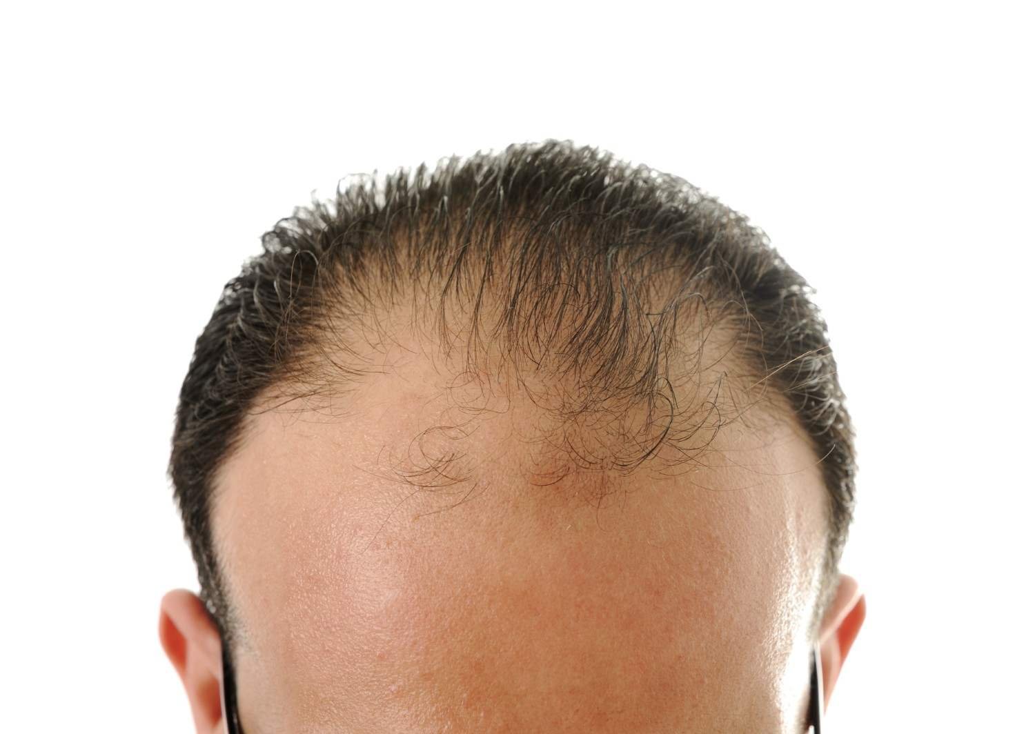 Hair Transplant Bekasi
