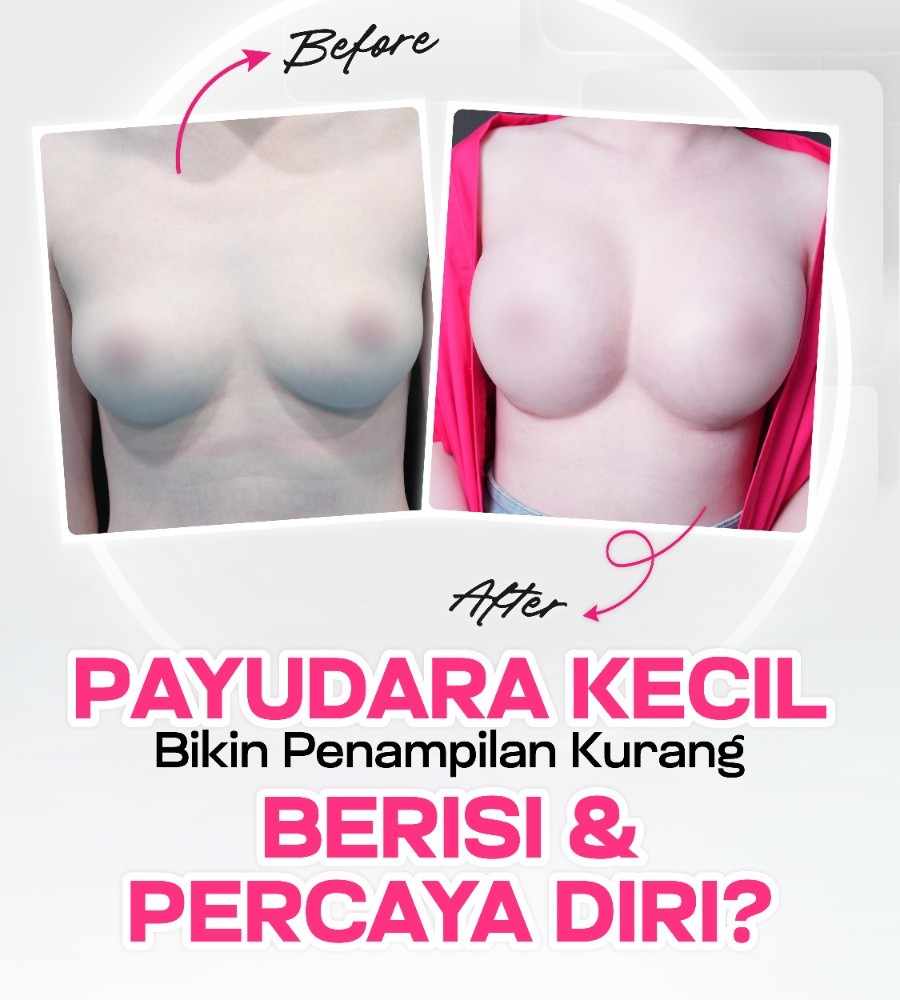 Breast Implant Surgery Indonesia
