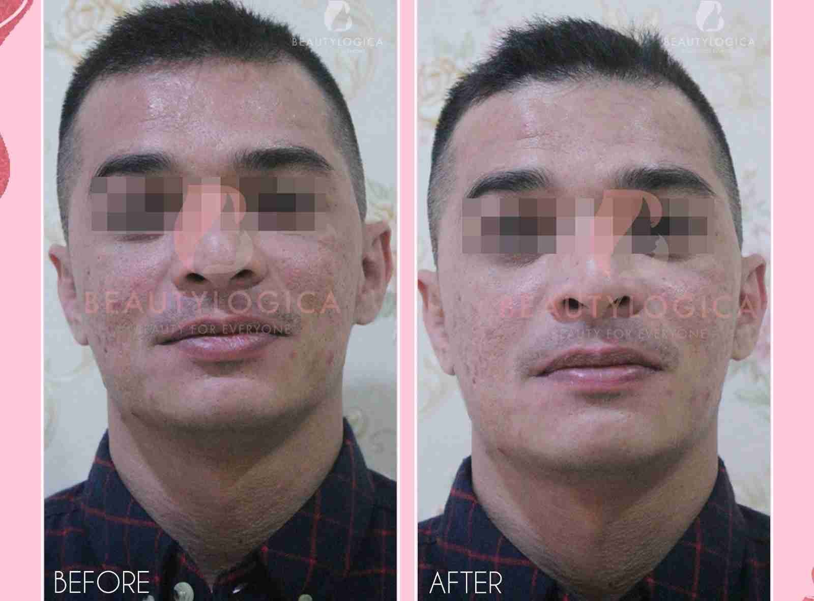 Treatment Jerawat di Balikpapan