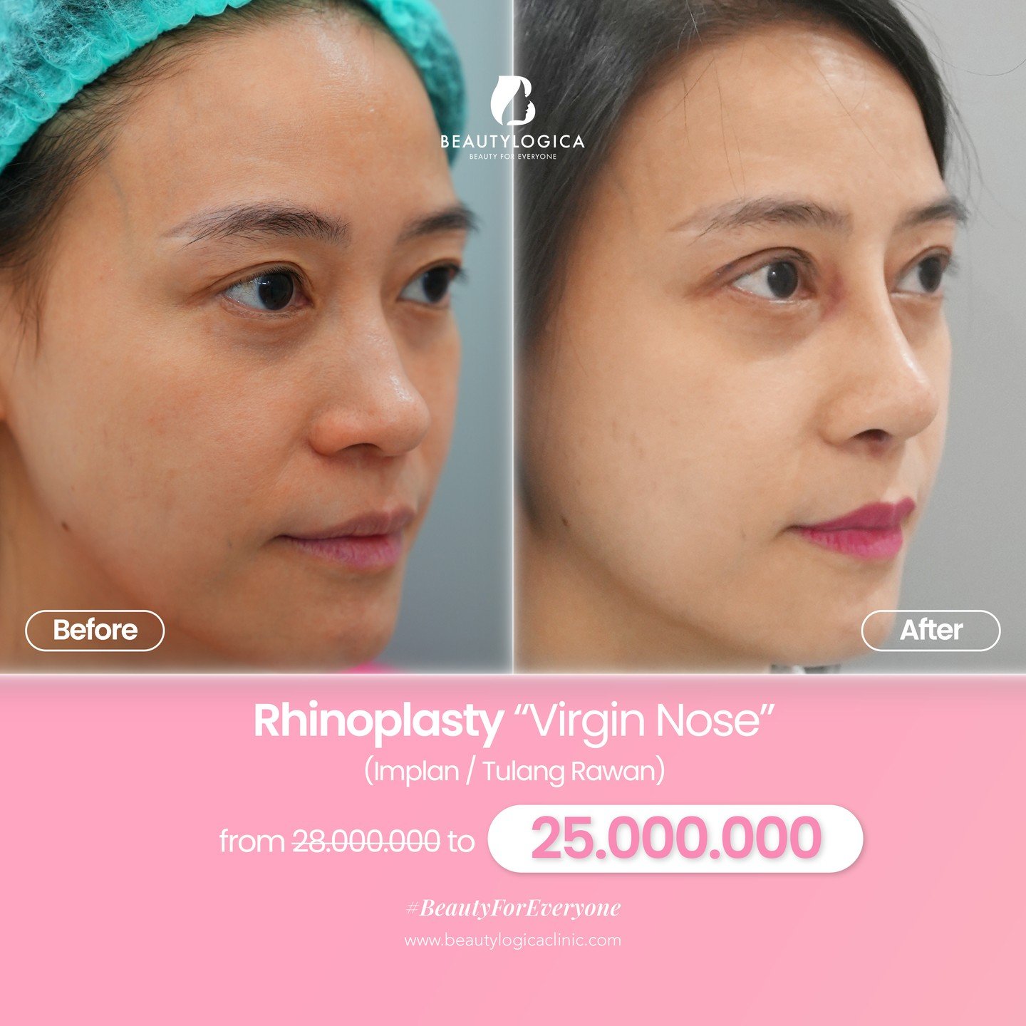 Rhinoplasty Memancungkan Hidung di Mangga Besar Jakarta Barat