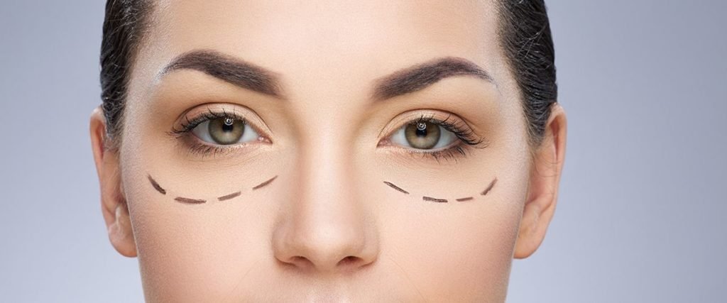 Blepharoplasty Bekasi