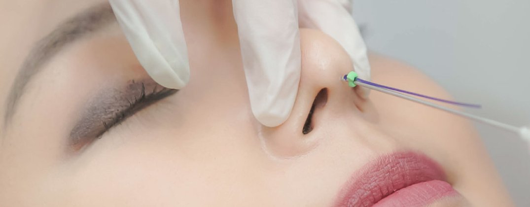 Nose Threadlift