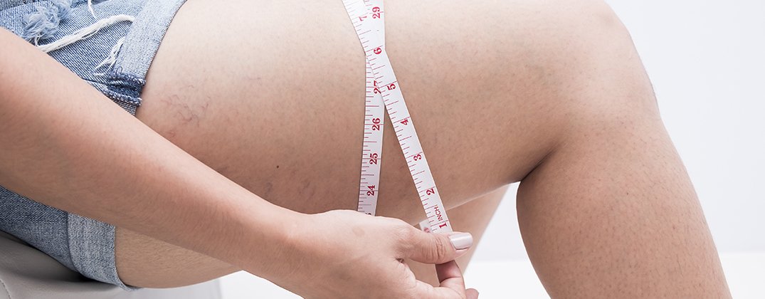 Thigh Lift